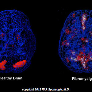 fibrobrain.jpg